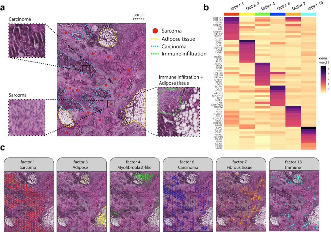 FFPE空間轉錄組解析卵巢癌肉瘤免疫浸潤過程[4]
